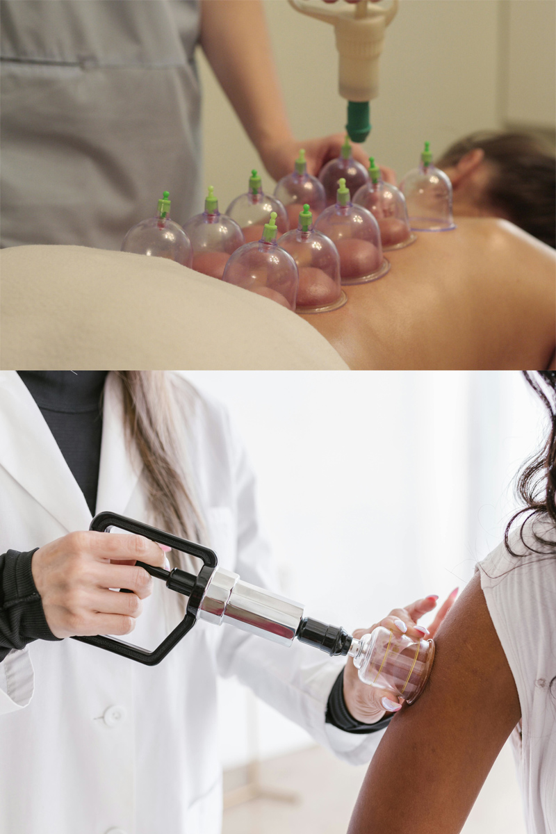 cupping02
